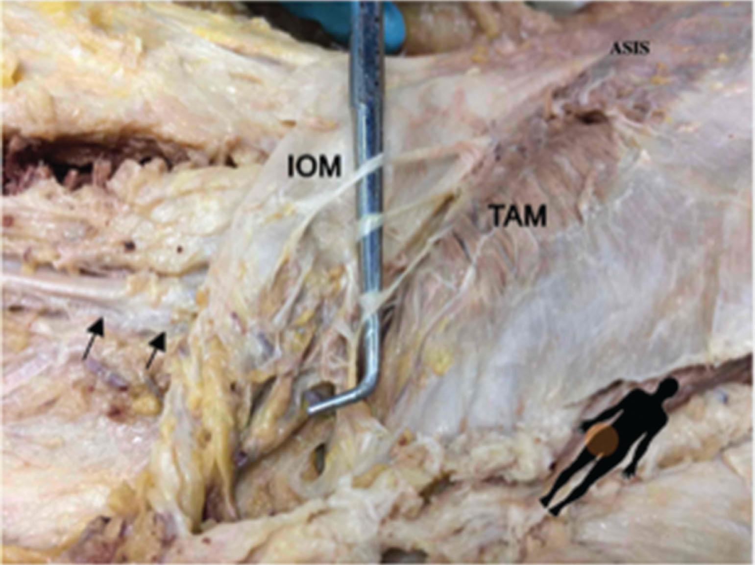 Figure 17.4, The ilioinguinal nerve (IIN) perforates the transversus abdominis muscle (TAM) and communicates with the iliohypogastric nerve (IHN) in the plane between the TAM and the internal oblique muscle (IOM). There can be several branches of the IHN/IIN, as shown isolated by the nerve hook. The arrows point to the femoral artery/vein/nerve complex. The body silhouette shows the orientation of the image. ASIS , Anterior superior iliac spine.