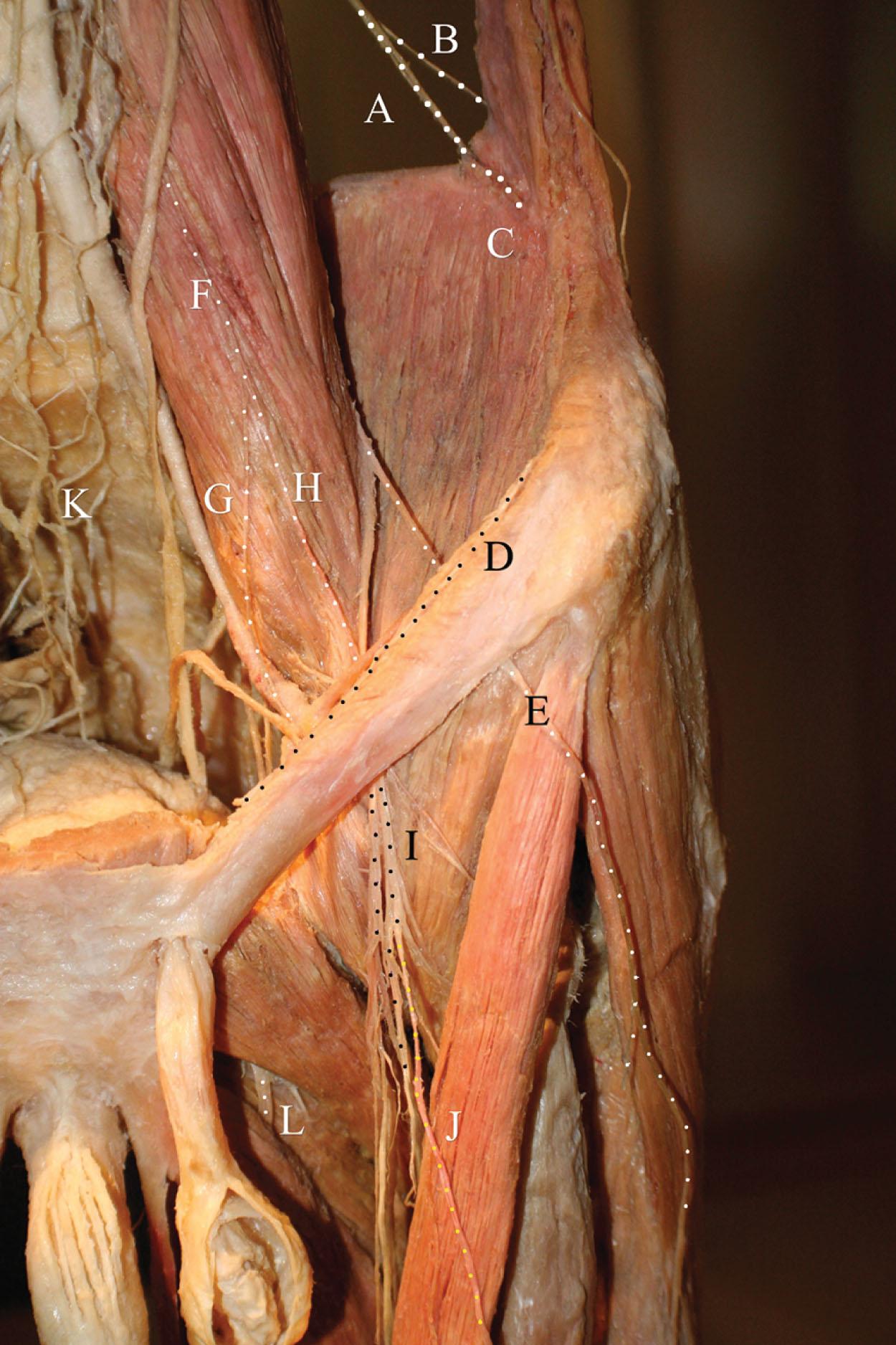 Figure 17.5, Groin nerves. A = ilioinguinal nerve, B = iliohypogastric nerve, C = site of ilioinguinal nerve entrapment at the external oblique, D = ilioinguinal nerve over the inguinal ligament, E = lateral femoral cutaneous nerve, F = genitofemoral nerve, G = genital branch of the genitofemoral nerve, H = femoral branch of the genitofemoral nerve, I = femoral nerve, J = saphenous nerve, K = inferior hypogastric plexus, L = obturator nerve.