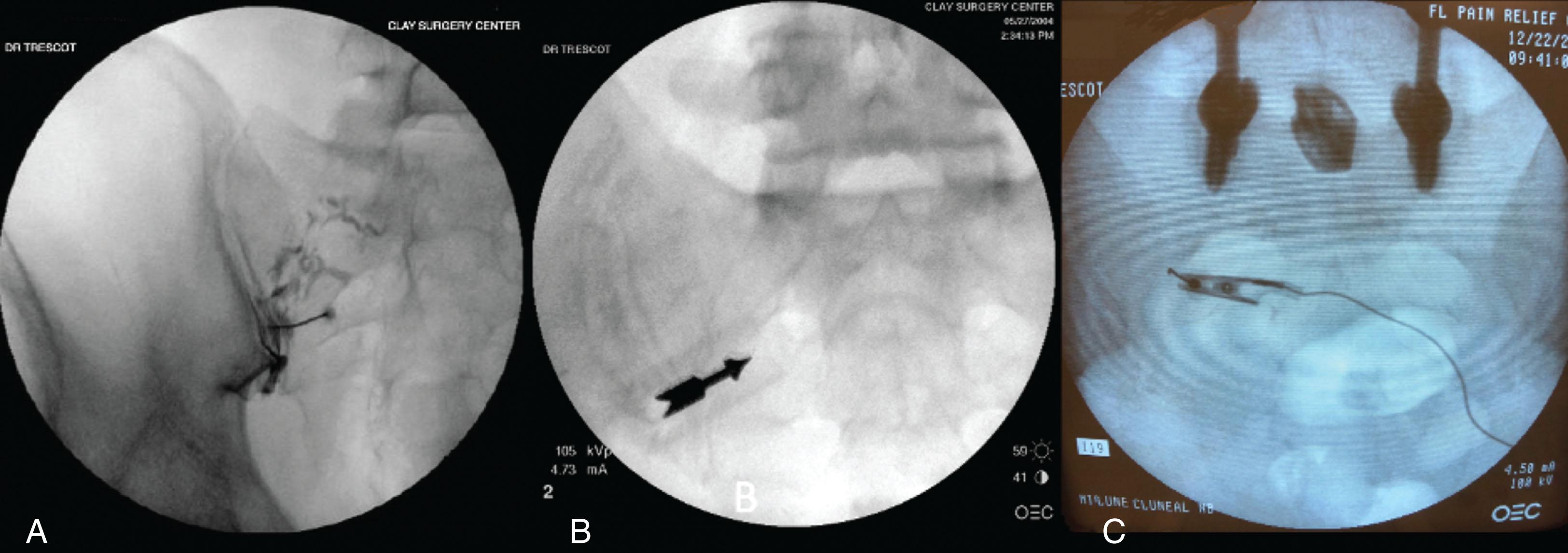 Figure 20.4, Fluoroscopy image of middle cluneal nerve injection at S2. A , Medial extravasation of contrast along the middle cluneal nerve during an intraarticular sacroiliac joint injection. B , Location of tenderness and injection site at the lateral border of the foramen. C , Injection with peripheral needle stimulator.