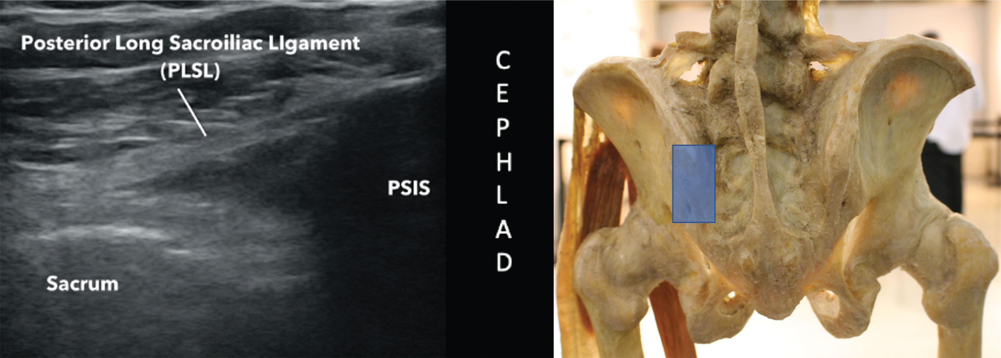 Figure 20.6, Ultrasound image of the long posterior sacroiliac ligament, with skeleton for reference. Blue box on the skeleton represents the ultrasound probe orientation. PSIS , Posterior superior iliac spine.