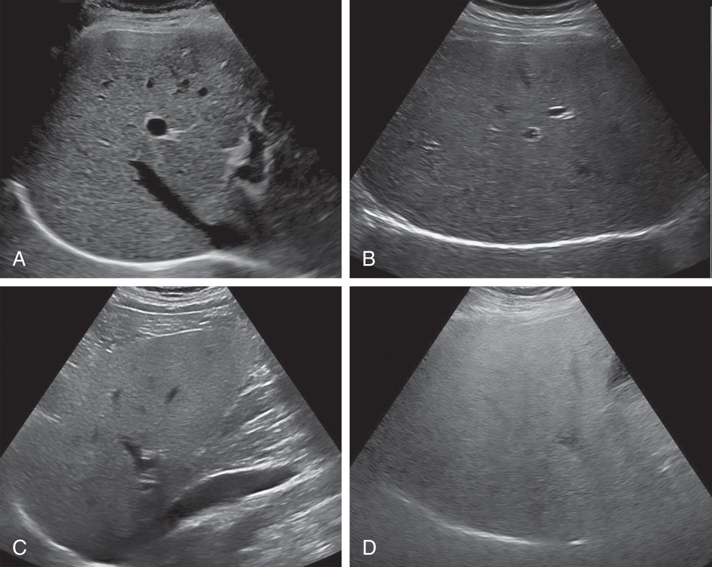 Noninvasive assessment of liver steatosis with ultrasound techniques ...