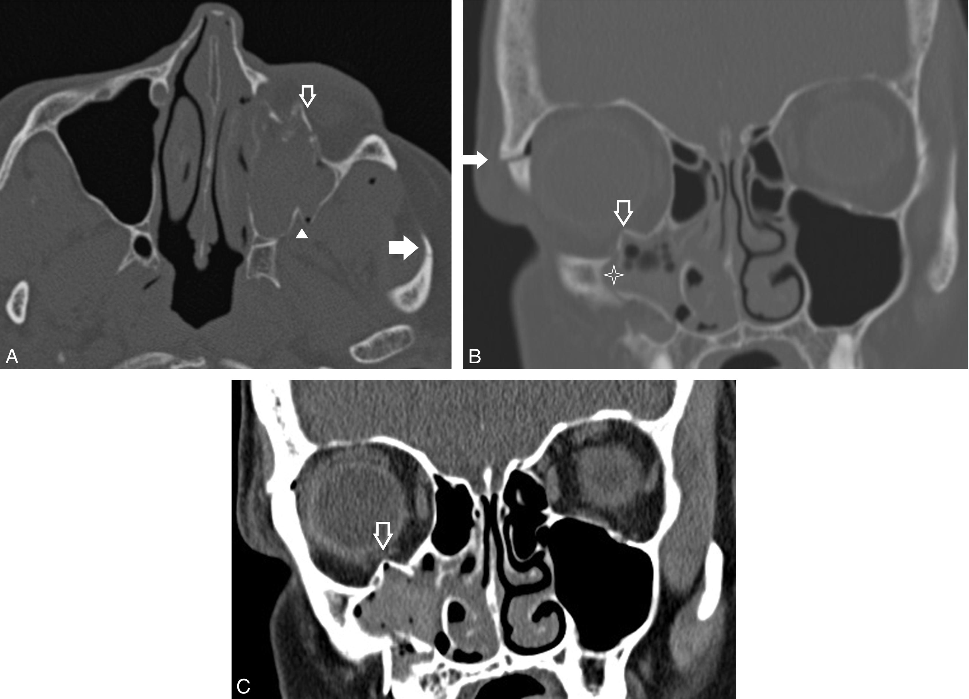 Radiologic Evaluation of the Orbit: Computed Tomography and Magnetic ...