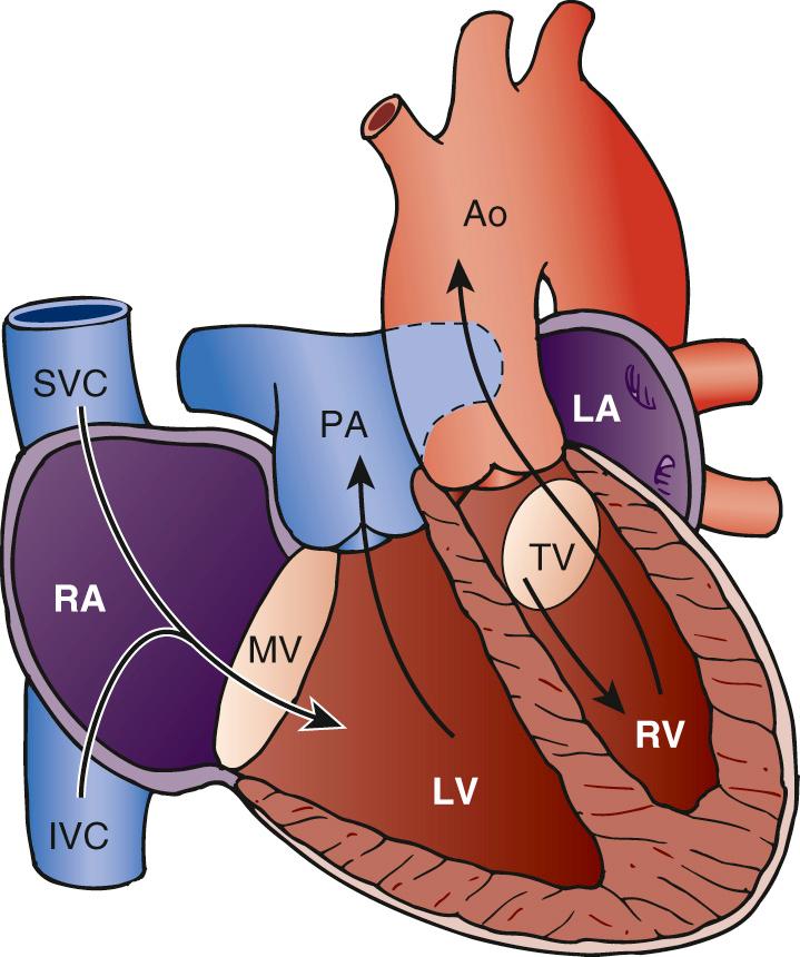 Surgery for Congenitally Corrected Transposition of the Great Arteries ...