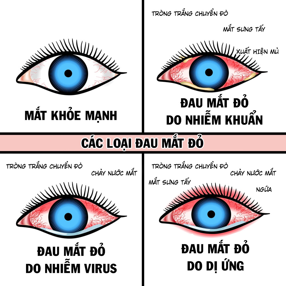 Tổng quan về bệnh đau mắt đỏ là gì? Nguyên nhân, dấu hiệu và cách ...