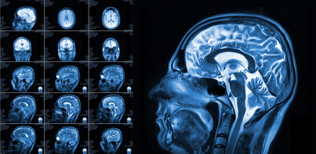 Mri Brain Scan Anatomy