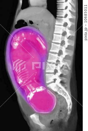 CT scan of abdomen of 25 year old pregnant woman with full term fetus. 10685011