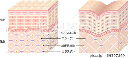 しわ　肌の断面図　ビフォアアフター 69397869