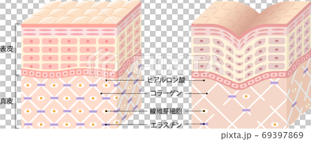 しわ　肌の断面図　ビフォアアフター 69397869