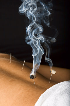 Patient receiving acupuncture treatment to his back