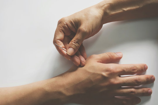 Acupuncture treatment on patient hand.