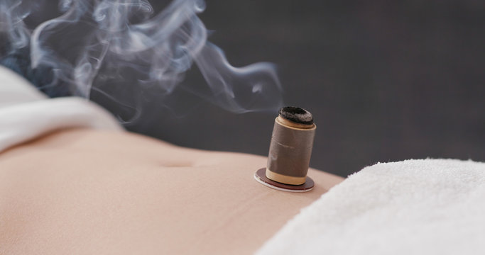 Chinese traditional medicine moxibustion therapy