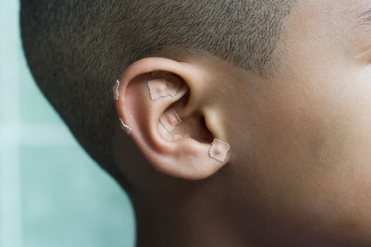 Auriculotherapy, or auricular therapy, or ear acupuncture, or auriculoacupuncture is a form of alternative medicine based on the idea that the ear is a microsystem which reflects the entire body.