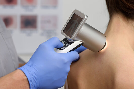 Digital dermatoscopy of moles. A dermatologist-oncologist examines the patient's moles using a dermatoscope. Prevention and early diagnosis of skin melanoma. Dermatological clinic. Close-up shot.