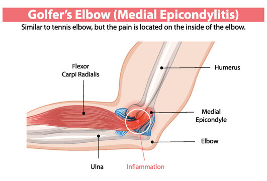 Detailed diagram of medial epicondylitis in the elbow