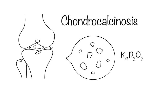 Chondrocalcinosis