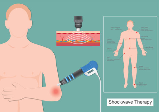 Shockwave therapy for tennis elbow (lateral epicondylitis)