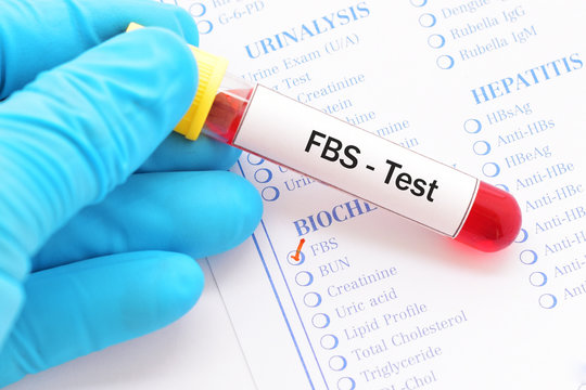 Blood sample with requisition form for fasting blood sugar (FBS) test, diagnosis for diabetes
