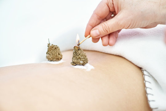 Woman being treated with acupuncture and moxibustion treatments