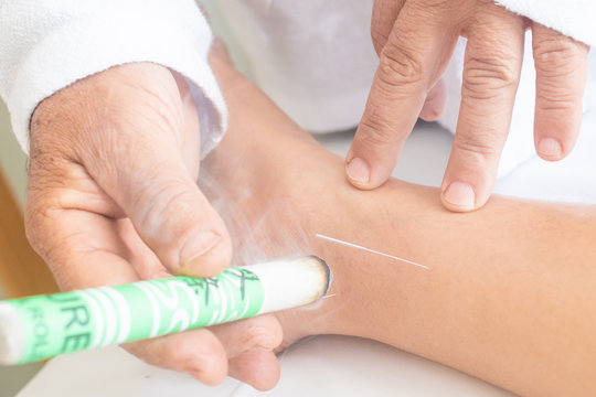 Woman being treated with acupuncture and moxibustion treatments.