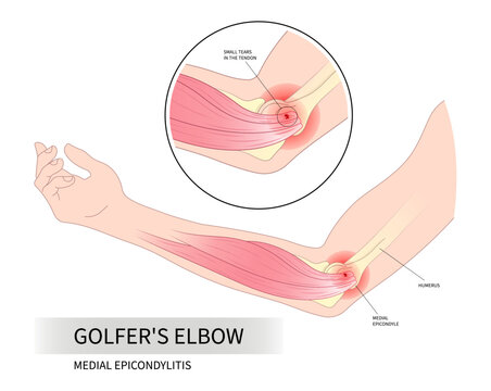 Golfer's elbow pain sport injury in pronation wrist common radial flexion rotator cuff of Cozen's with Mill's test nerve and Tricep extensor carpi radialis brevis muscle rupture