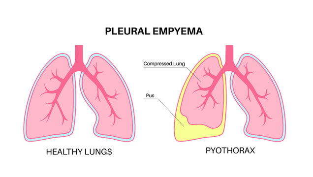 Empyema Images – Browse 1,106 Stock Photos, Vectors, and Video | Adobe ...