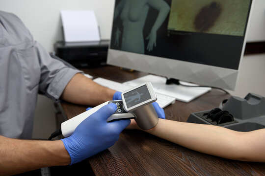 Digital dermatoscopy of moles. A dermatologist-oncologist examines the patient's moles using a dermatoscope and computer. Prevention and early diagnosis of skin melanoma. Dermatological clinic.