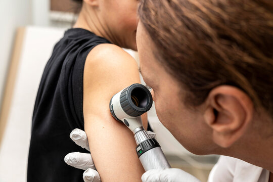 dermatologist examines birthmarks on the patient's skin with a dermatoscope. Dermatology, skin mole examining. looking for signs of melonoma or skin cancer.
