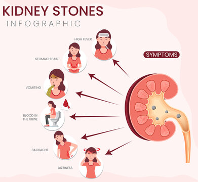 Kidney Stones Symptoms Infographic Identifying Pain, Nausea, and Urinary Discomfort