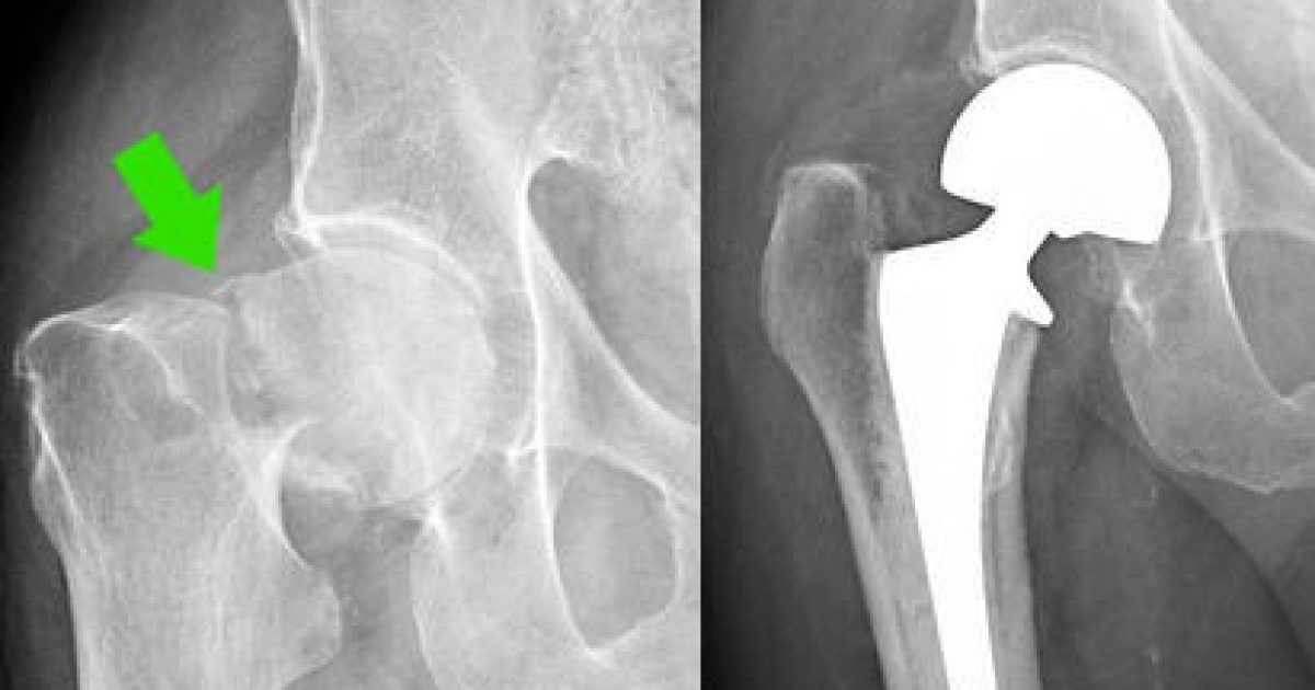 Femoral Neck Fracture Nomenclature Uw Emergency Radio - vrogue.co