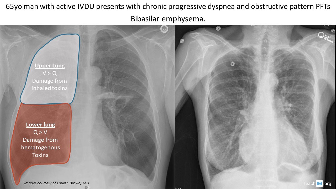 Obstructive lung diseases Archives - teachIM