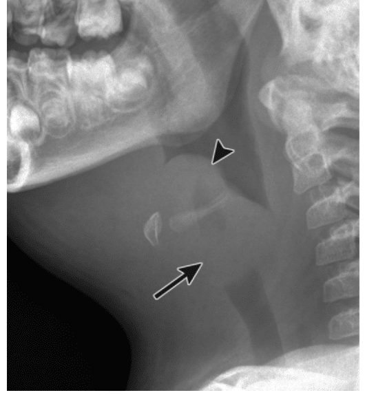 Thumb Sign Epiglottitis