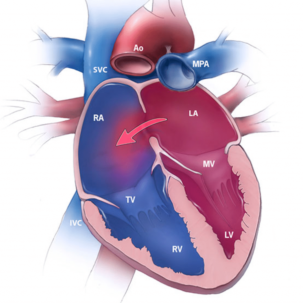 Congenital Heart Defects - TeachMePaediatrics