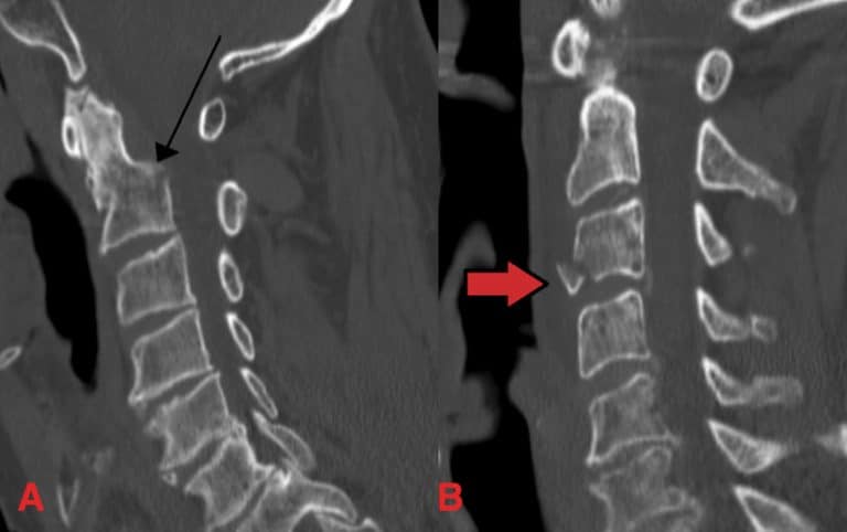 Cervical Transverse Process Fracture