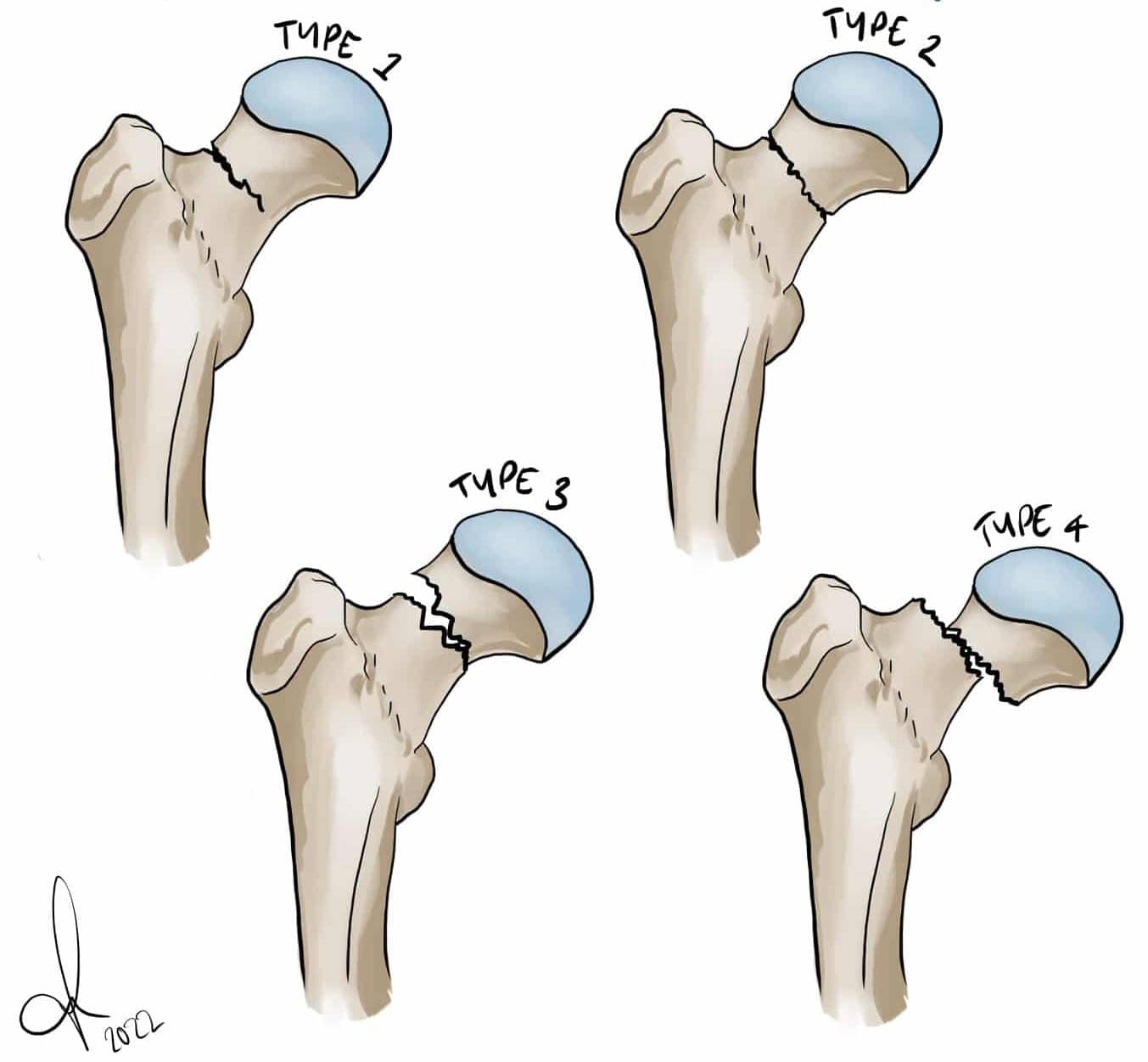 Distal Femur Fracture Classification