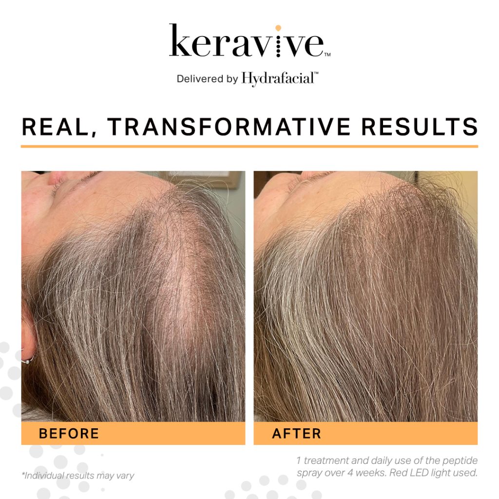 Keravive before and after for a female showing how hair thickens