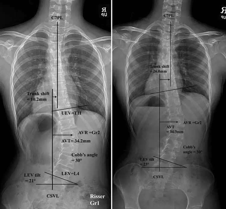 Thoracolumbar Scoliosis Diagnosis