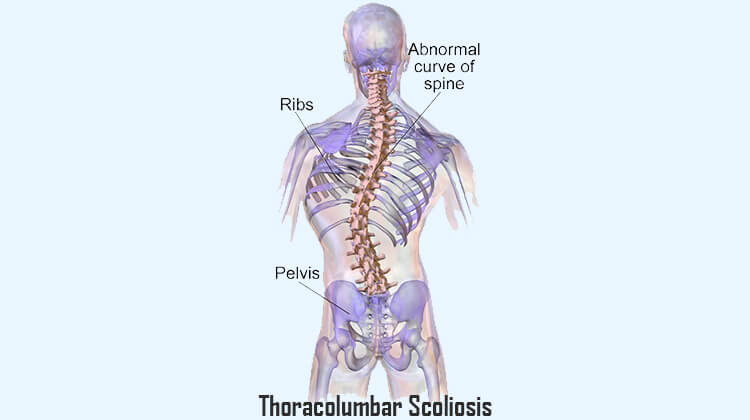 Thoracolumbar Scoliosis