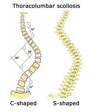 sign and symptoms of Thoracolumbar Scoliosis