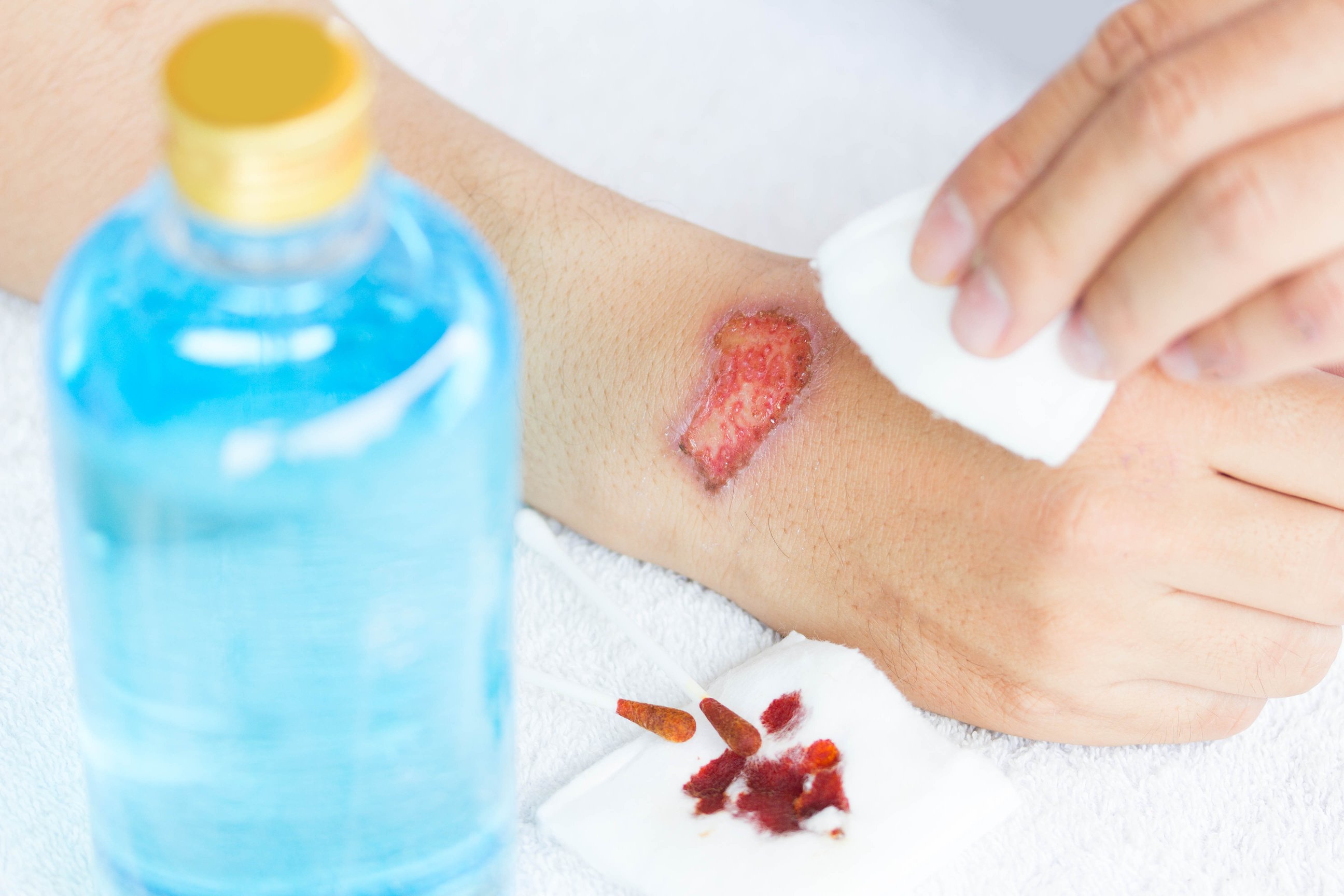 Introduction Of Wound Care