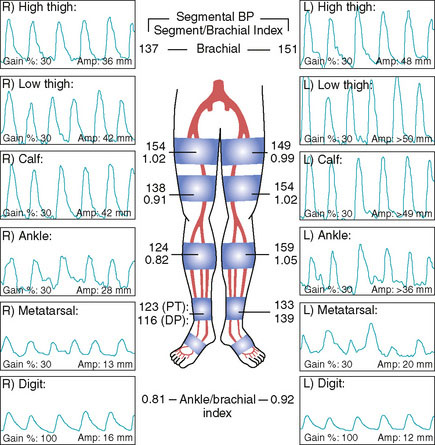 Distal Superficial Femoral Artery