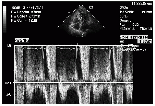 Hypertrophic and Other Cardiomyopathies | Thoracic Key