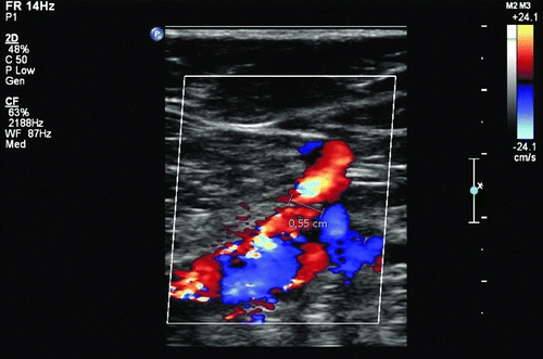 latrogenic Femoral Arteriovenous Fistulas | Thoracic Key