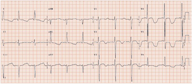 QT interval and U wave abnormalities | Thoracic Key