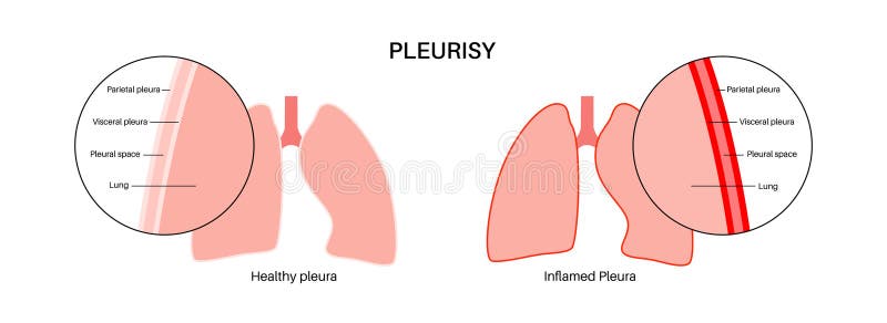 Pleurisy Inflammation Diseases Stock Vector - Illustration of visceral ...