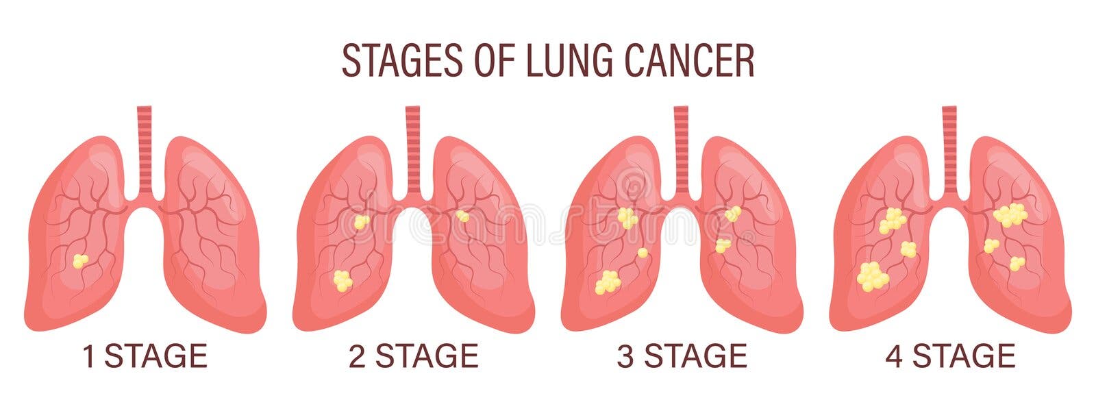 Lung infographic stock vector. Illustration of diagnostic - 32329844