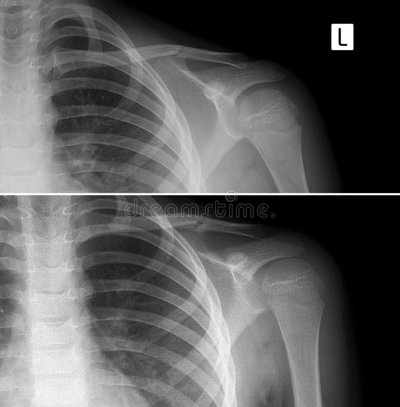 X-ray of the left collarbone. Fracture of clavicle. Consolidation of ...