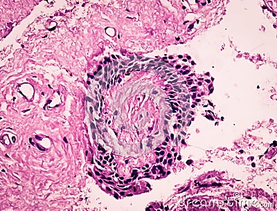 Histology Of Urachal Cyst. Photomicrograph Stock Image | CartoonDealer ...