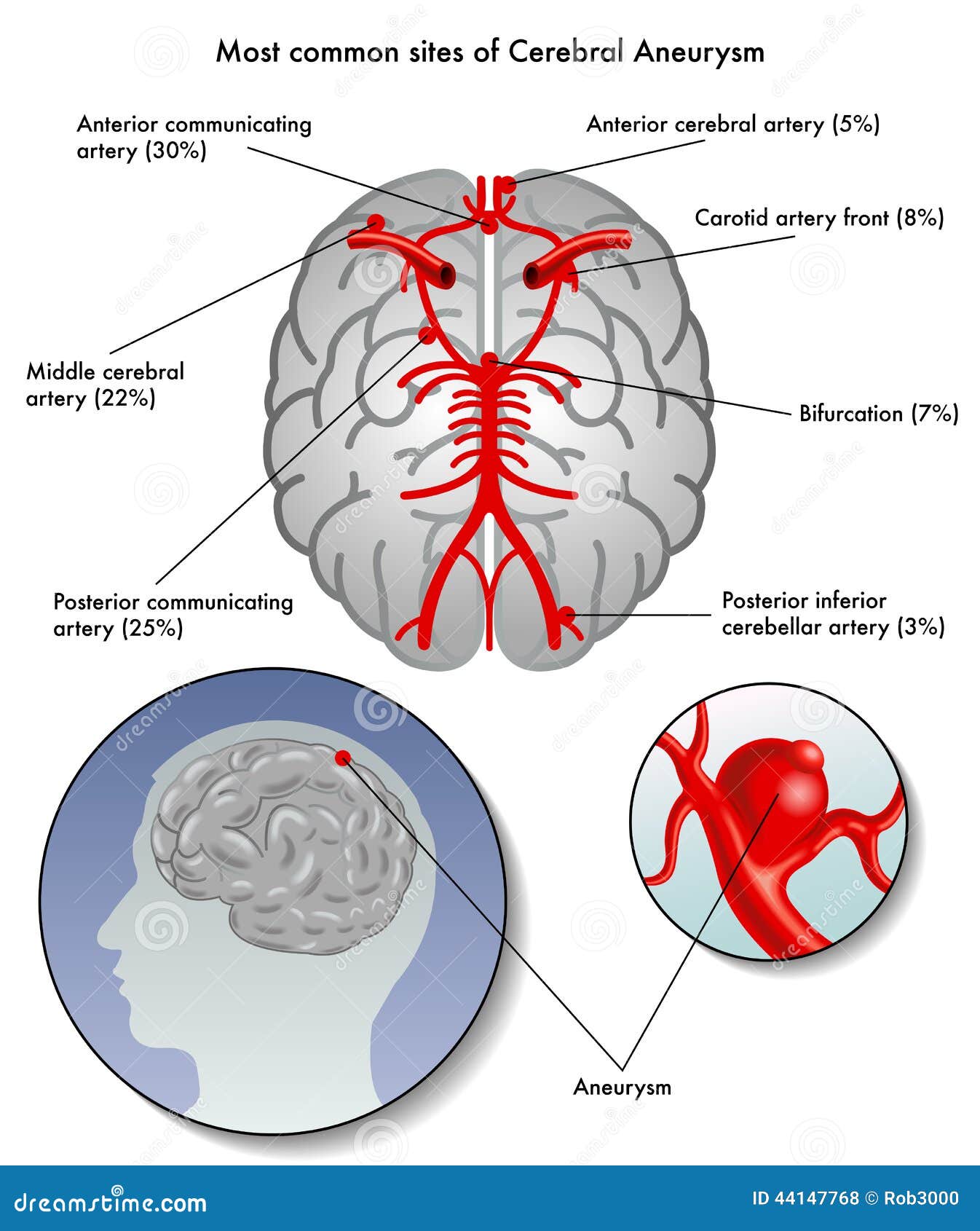 Cerebral aneurysm stock vector. Illustration of double - 44147768