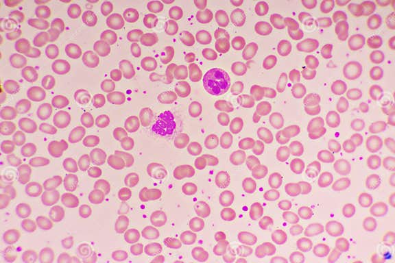 Essential Thrombocytosis Blood Smear with Neutrophil Cell Stock Photo ...