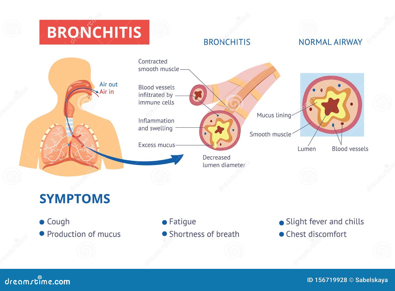 Healthy Airway and Bronchitis Diagnosis Symptoms Medical Banner Vector ...